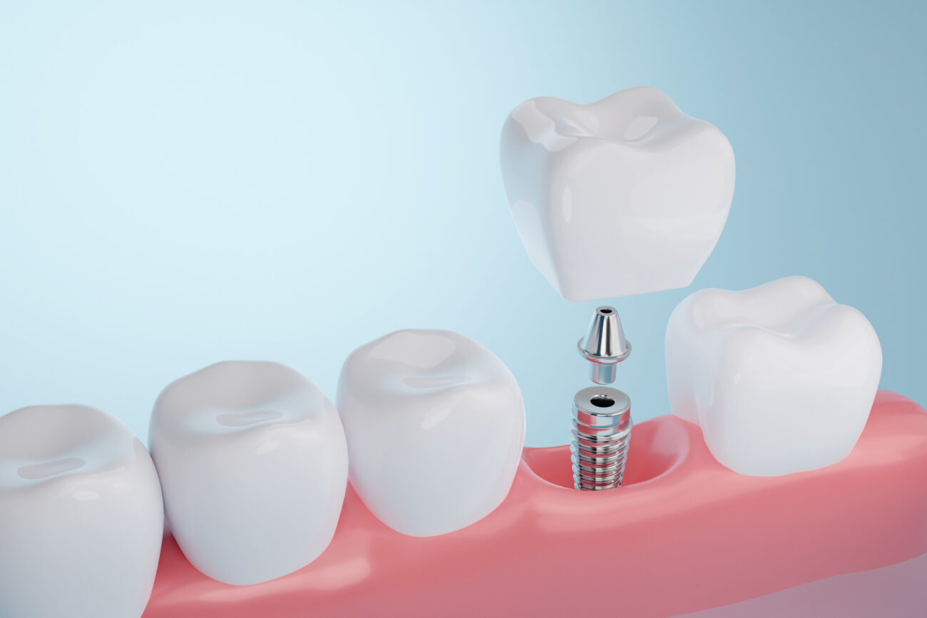 dental implants in tampa fl