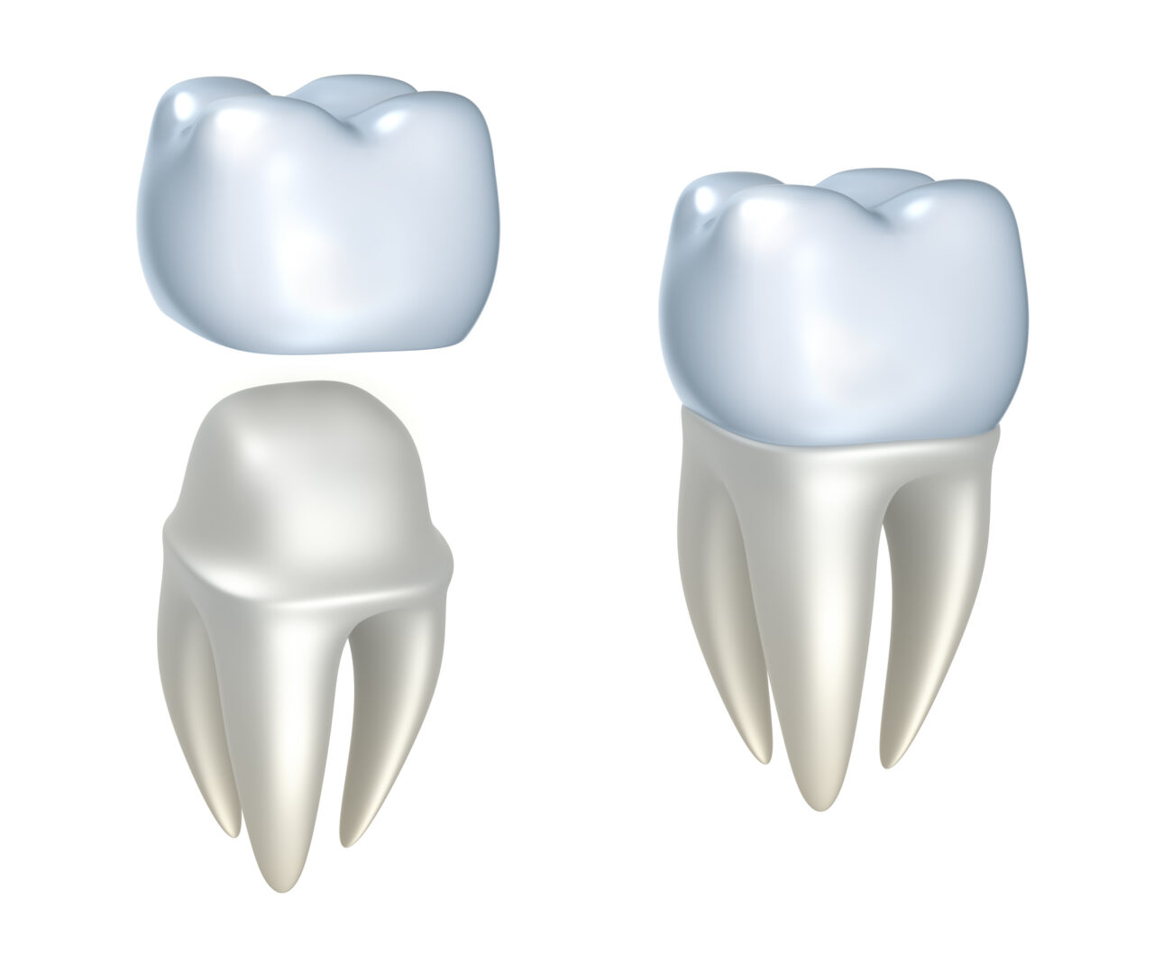 dental crowns in tampa bay, fl.