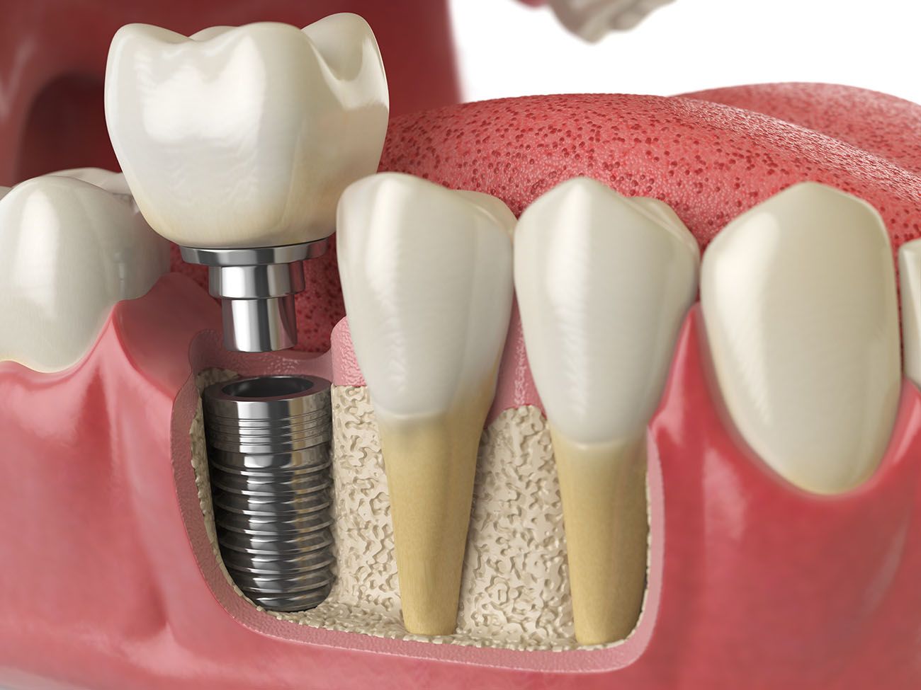 single dental implant replaces missing tooth