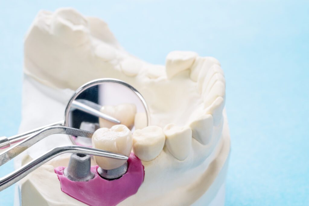 How Long Is The Dental Implant Process?