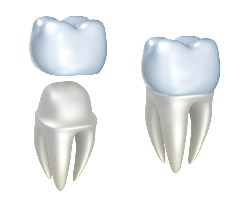 A DENTAL CROWN in TAMPA FL can be used to help restore your tooth after a variety of issues
