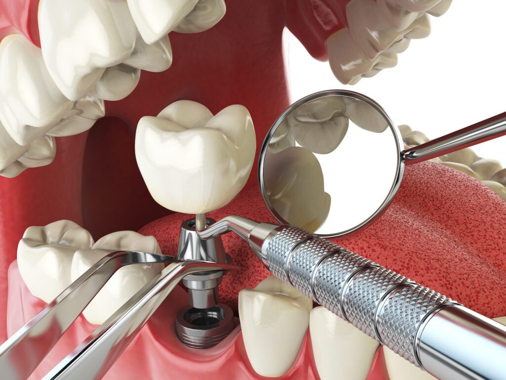 DENTAL IMPLANTS in TAMPA FL require careful attention and maintenance for healthy restoration