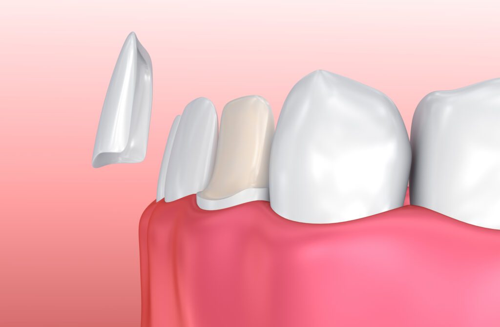 PORCELAIN VENEERS in TAMPA FL can help address many issues, but they may not be available for everyone