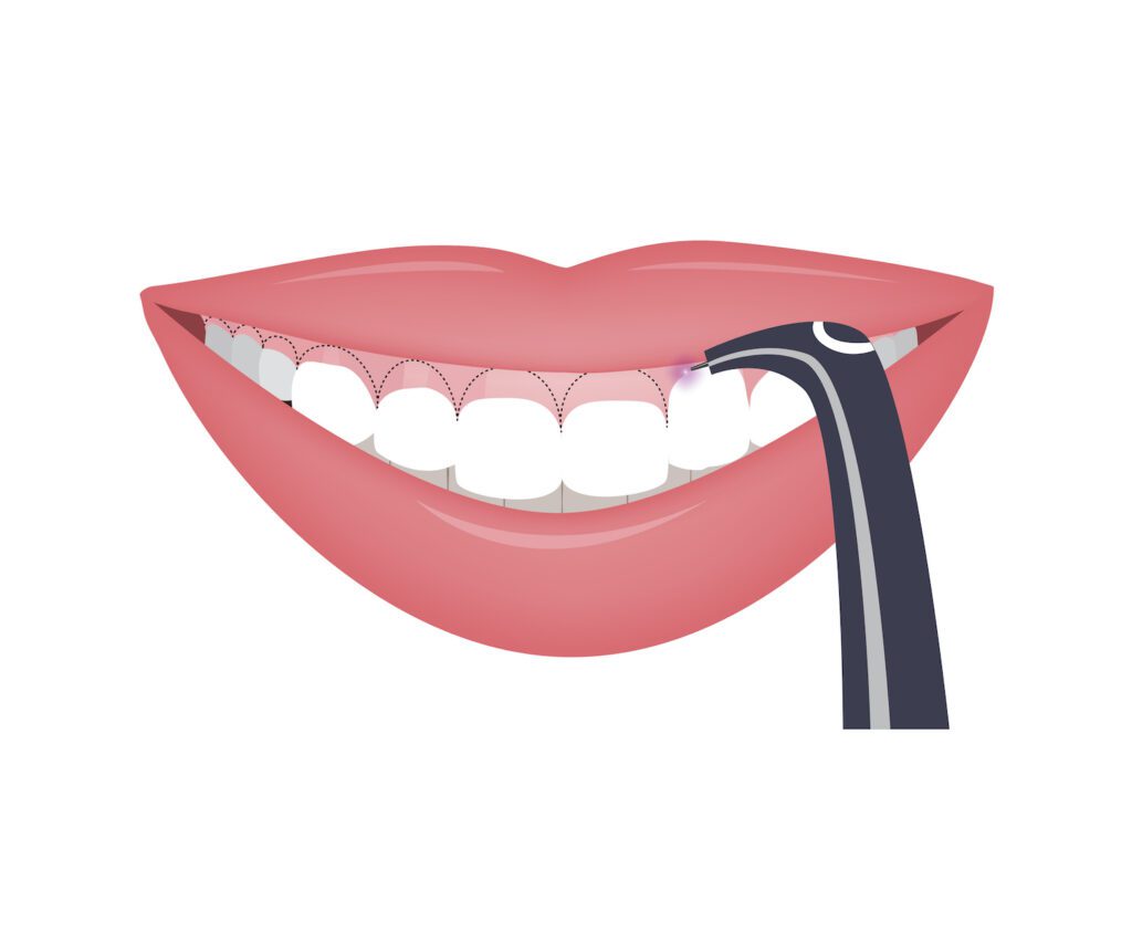 Laser dentistry represents a significant advancement in dental care, providing a wide range of treatments with enhanced precision and comfort.